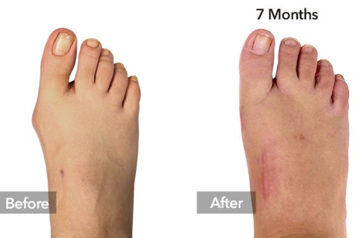 Malunion Surgery